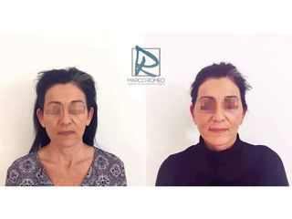 Antes y después Lifting facial