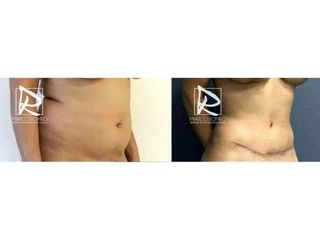 Antes y después Abdominoplastia