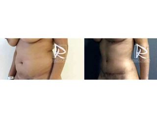 Antes y después Abdominoplastia