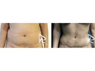 Antes y después Abdominoplastia