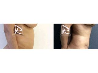 Antes y después Abdominoplastia