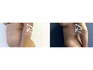 Antes y después Abdominoplastia