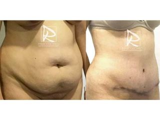 Antes y después Abdominoplastia