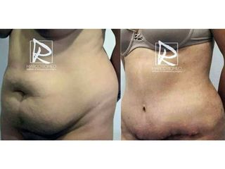 Antes y después Abdominoplastia