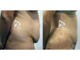 Antes y después Abdominoplastia