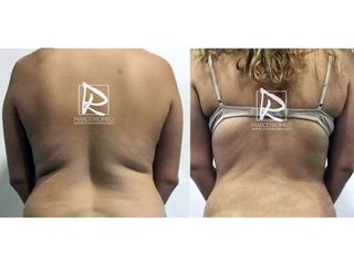 Antes y después Abdominoplastia