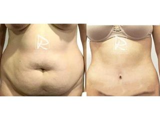 Antes y después Abdominoplastia