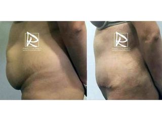 Antes y después Abdominoplastia