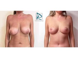 Antes y después Mommy Makeover