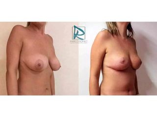 Antes y después Mommy Makeover