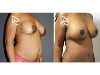 Antes y después Mommy Makeover