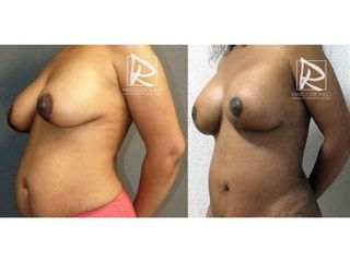 Antes y después Mommy Makeover