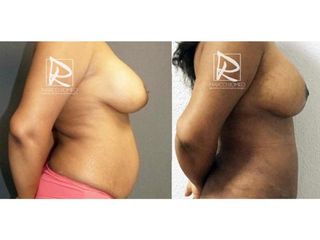 Antes y después Mommy Makeover