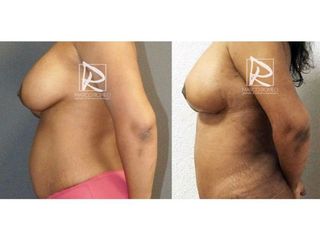 Antes y después Mommy Makeover