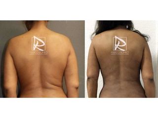 Antes y después Mommy Makeover