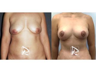 Antes y después Mommy Makeover