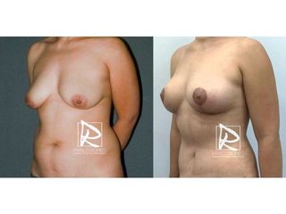 Antes y después Mommy Makeover