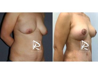 Antes y después Mommy Makeover