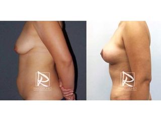 Antes y después Mommy Makeover