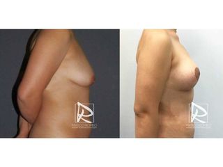 Antes y después Mommy Makeover