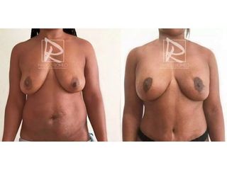 Antes y después Mommy Makeover