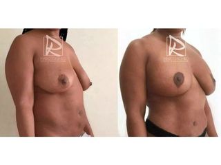 Antes y después Mommy Makeover