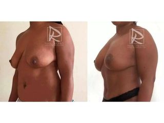 Antes y después Mommy Makeover