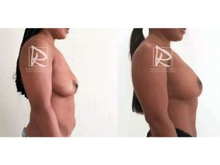Antes y después Mommy Makeover