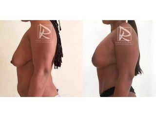 Antes y después Mommy Makeover