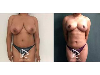 Antes y después Mommy Makeover