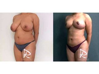 Antes y después Mommy Makeover