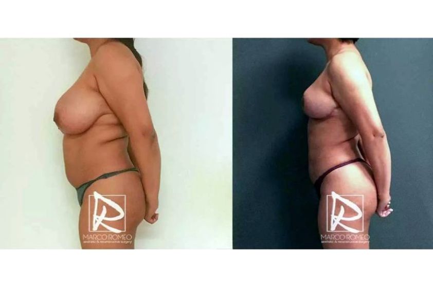 Lipofilling antes y después - 643234