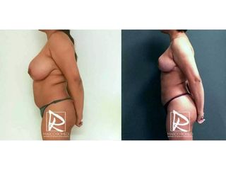 Antes y después Mommy Makeover