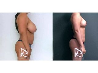 Antes y después Mommy Makeover
