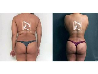 Antes y después Mommy Makeover
