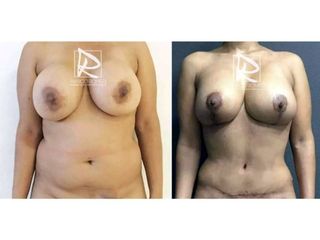 Antes y después Mommy Makeover