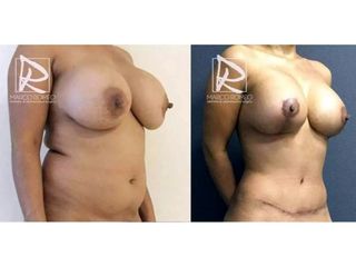 Antes y después Mommy Makeover