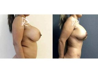 Antes y después Mommy Makeover