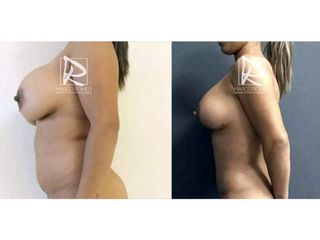 Antes y después Mommy Makeover