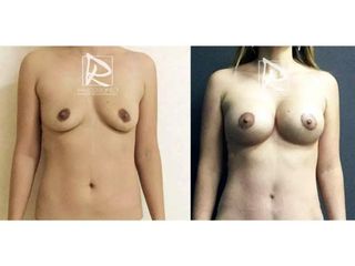 Antes y después Mommy Makeover