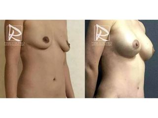 Antes y después Mommy Makeover