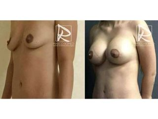 Antes y después Mommy Makeover