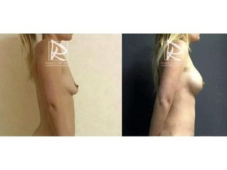 Antes y después Mommy Makeover