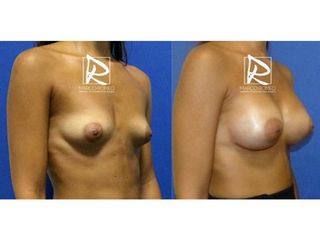 Antes y después Aumento de pecho