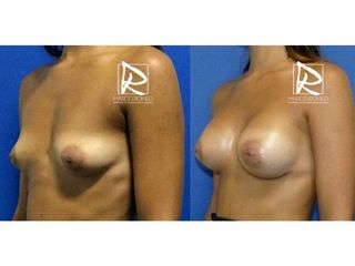 Antes y después Aumento de pecho