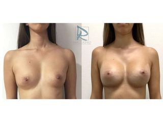 Antes y después Aumento de pecho