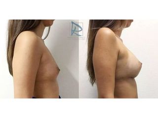 Antes y después Aumento de pecho