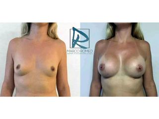 Antes y después Aumento de pecho
