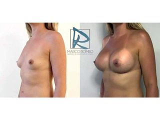 Antes y después Aumento de pecho