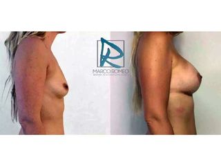 Antes y después Aumento de pecho